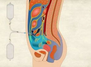 可人腹膜注意事項