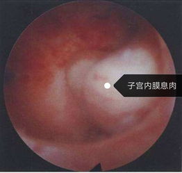 手術(shù)后,注意事項,宮腔鏡