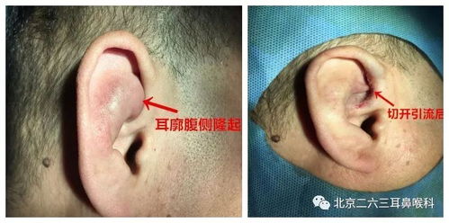 耳廓假性囊腫注意事項