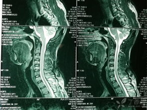 頸椎骨折翻身注意事項,頸椎骨折牽引翻身注意事項,頸椎骨折病人翻身時注意事項
