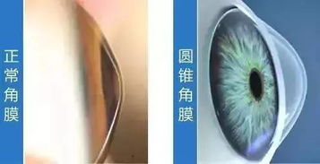圓錐角膜要注意事項