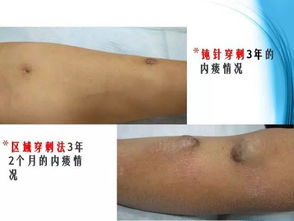 注意事項(xiàng),血透拔針