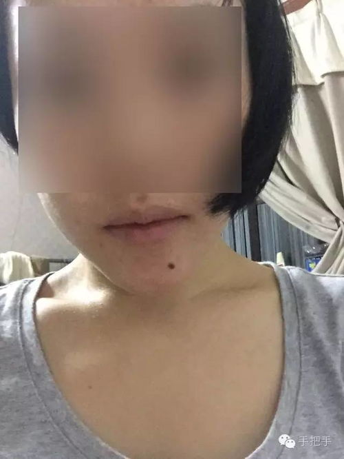 注意事項,電燒法點痣