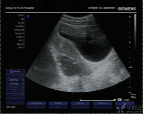 婦科做b超必須空腹嗎超注意事項