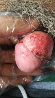 陰莖,激光,注意事項