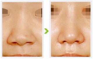 鼻孔,縮小,注意事項,手術(shù)