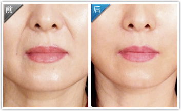 鼻唇溝填充物注意事項