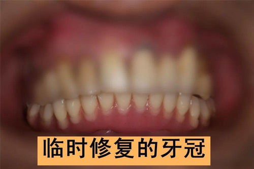 臨時(shí)牙冠上后注意事項(xiàng)