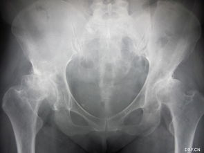 術(shù)后,置換,關(guān)節(jié),注意事項(xiàng)