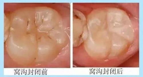 封閉牙齒后注意事項