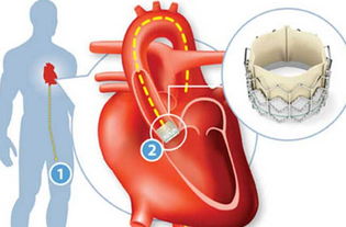 瓣膜,做過,注意事項(xiàng),心臟