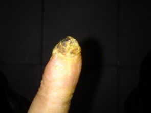 手指割傷飲食注意事項(xiàng)