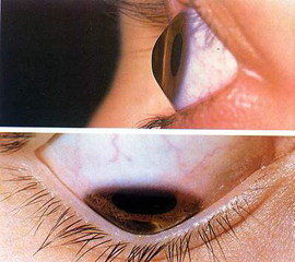 圓錐角膜用眼注意事項