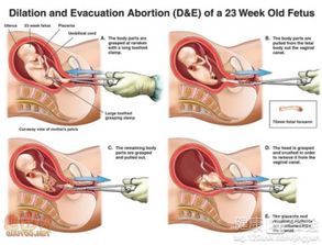 刮宮,無痛,注意事項
