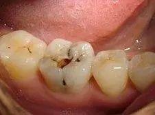 剛種完牙注意事項(xiàng)