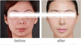 愛(ài)問(wèn),新浪,祛斑,激光