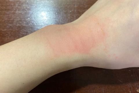 貼膏藥有哪些注意事項