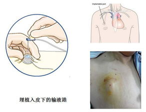 乳腺癌術(shù)前化療注意事項(xiàng),乳腺癌術(shù)后化療注意事項(xiàng),乳腺癌化療后注意事項(xiàng)