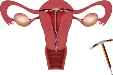 上環(huán),門診,術(shù)前,注意事項