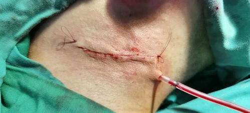 鰓裂囊腫術(shù)后注意事項(xiàng),前庭大腺囊腫術(shù)后注意事項(xiàng),會厭囊腫術(shù)后注意事項(xiàng)