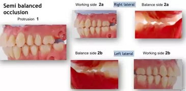上頜架的注意事項(xiàng)