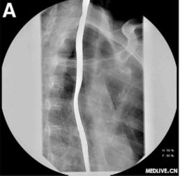食管鋇餐造影注意事項