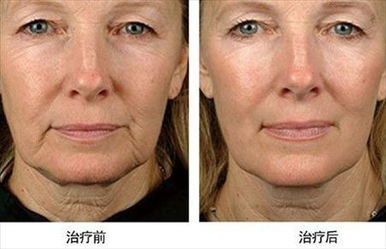 做完塑美極注意事項