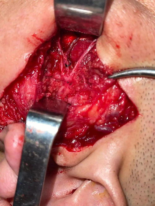 腮腺手術(shù)術(shù)中注意事項,腮腺瘤術(shù)后注意事項,腮腺瘤術(shù)后飲食注意事項