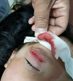 5歲半孩子手骨折注意事項(xiàng)