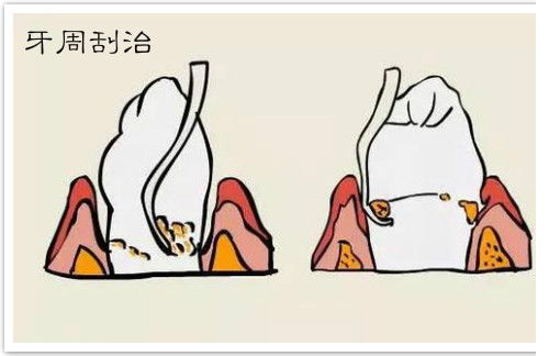 牙齒刮治后的注意事項(xiàng)