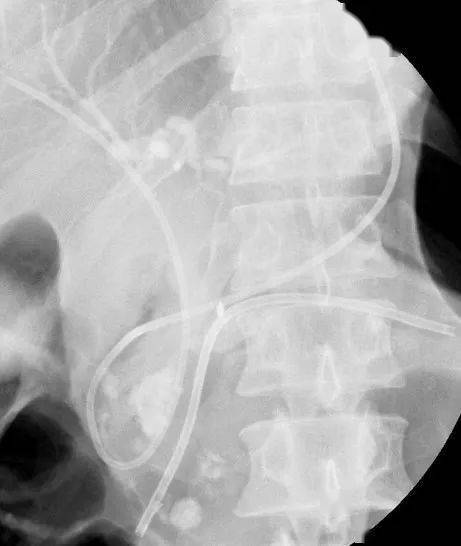 胰管支架后注意事項