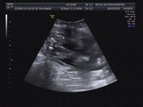 小男孩膀胱b超注意事項