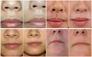 去唇毛要注意事項