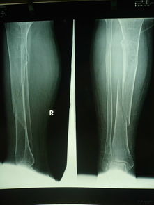 腓骨小頭骨折注意事項
