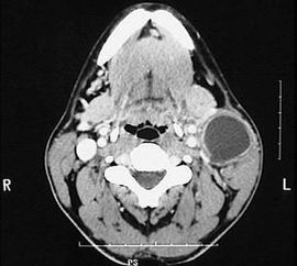 囊腫,注意事項(xiàng)