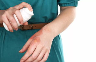 燙傷,注意事項(xiàng)