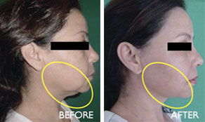 激光溶雙下巴注意事項