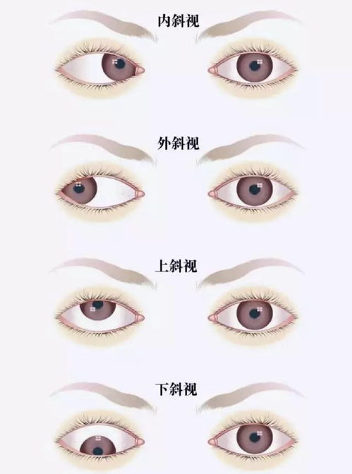 斜視,術(shù)后,注意事項,兒童