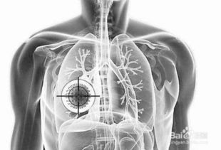 肺手術(shù)后應(yīng)注意事項(xiàng)