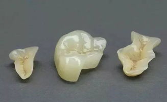 補(bǔ)牙,注意事項(xiàng)