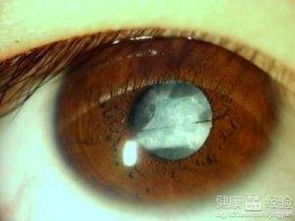 雙眼黃斑前膜的注意事項(xiàng)