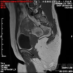 mri增強檢查注意事項和禁忌癥,mri增強檢查后注意事項,增強mri檢查需要注意事項