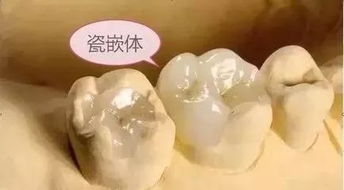 嵌體的適應(yīng)癥及臨床注意事項(xiàng)