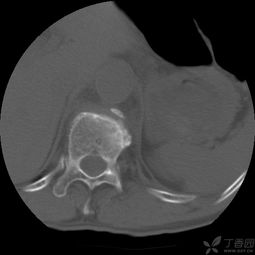 腰椎骨折手術(shù)后注意事項(xiàng),腰椎骨折手術(shù)麻醉注意事項(xiàng),腰椎骨折手術(shù)后恢復(fù)期注意事項(xiàng)