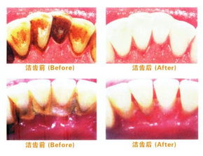 牙周炎第一次洗牙后注意事項,牙周炎洗完牙后注意事項,牙周炎治療后注意事項