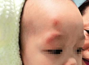 寶寶縫針后注意事項(xiàng),摔傷縫針后注意事項(xiàng),下巴摔傷縫針注意事項(xiàng)