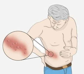 注意事項(xiàng),飲食,蛇盤瘡