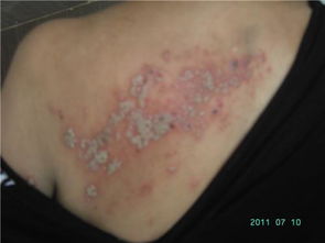 得了龍須瘡注意事項,龍須瘡飲食注意事項,龍須樹移栽注意事項