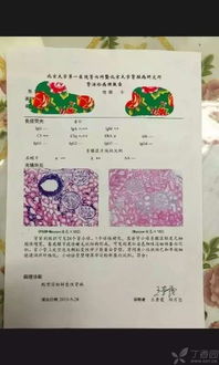 淀粉樣變腎病飲食注意事項