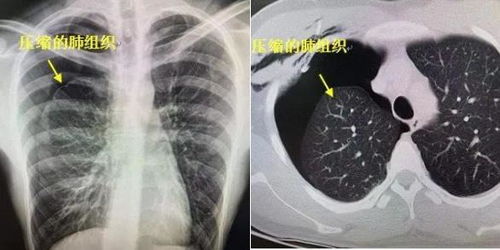 氣胸需要注意事項(xiàng)